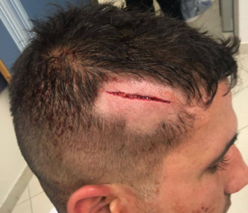 הפציעה החמורה