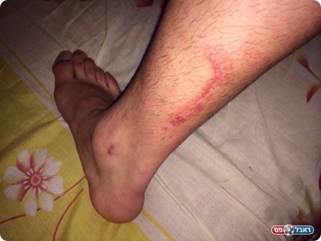 שלל פגיעות. רגל של שחקן חצור 