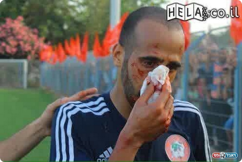 לא נעים. אבו ראס והאף הפצוע (מוחמד פדילה)