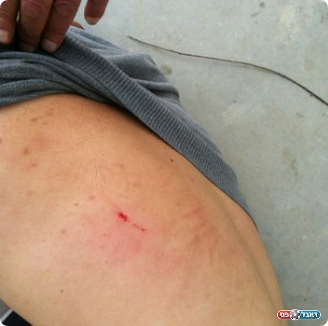 אבן או גדר? הפציעה של עמר